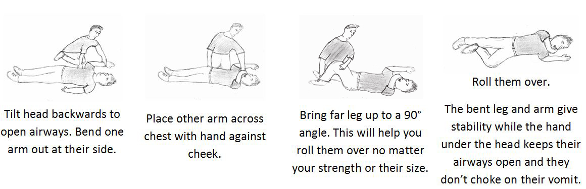 A diagram demonstrating how to place someone in the recovery position. If they are laying on their back, tilt the head backwards to open airways. Bend one arm out at their side. Place the other arm across chest with hand against cheek. Bring far leg up to a 90 degree angle. This will help you roll them over no matter your strength or their size. Roll them over. The bent leg and arm give stability while the hand under the head keeps their airways open and they don't choke on their vomit. 